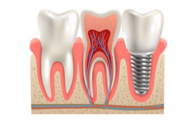 Ines Baždar Spajić – Dentalni implantati Đakovo